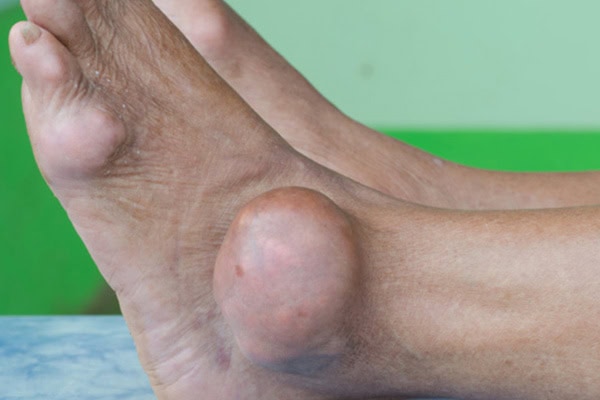 gout